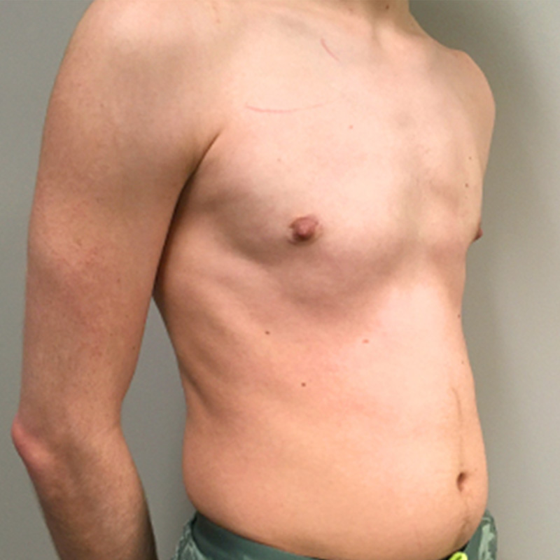 Ftm Keyhole Chest Reconstruction 07