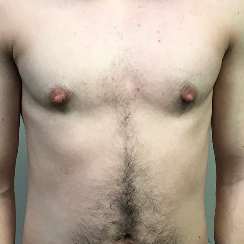 Ftm Keyhole Chest Reconstruction 03
