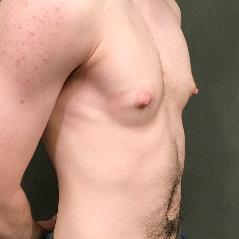 Ftm Keyhole Chest Reconstruction 03