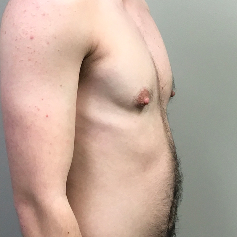 Ftm Keyhole Chest Reconstruction 03