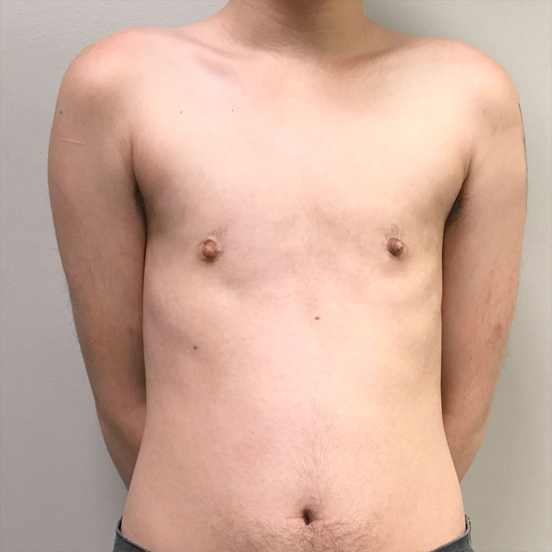Ftm Keyhole Chest Reconstruction 04