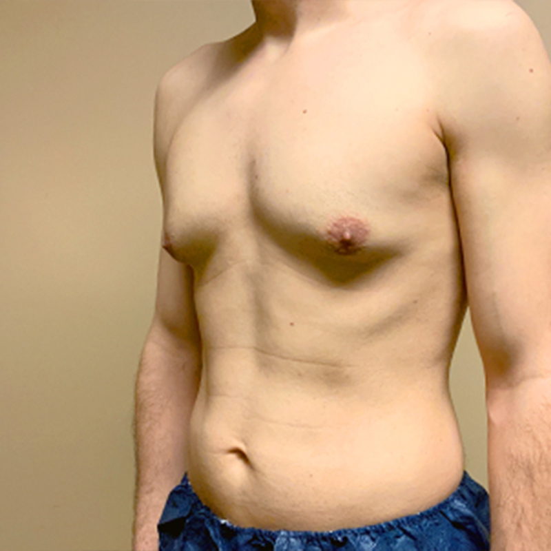 Ftm Keyhole Chest Reconstruction 01
