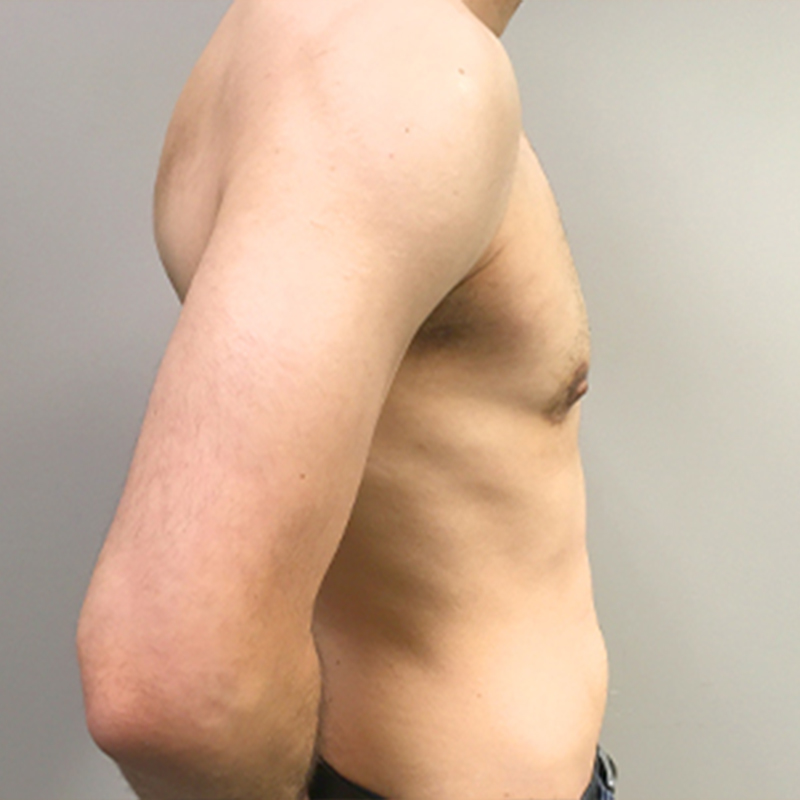 Ftm Keyhole Chest Reconstruction 07