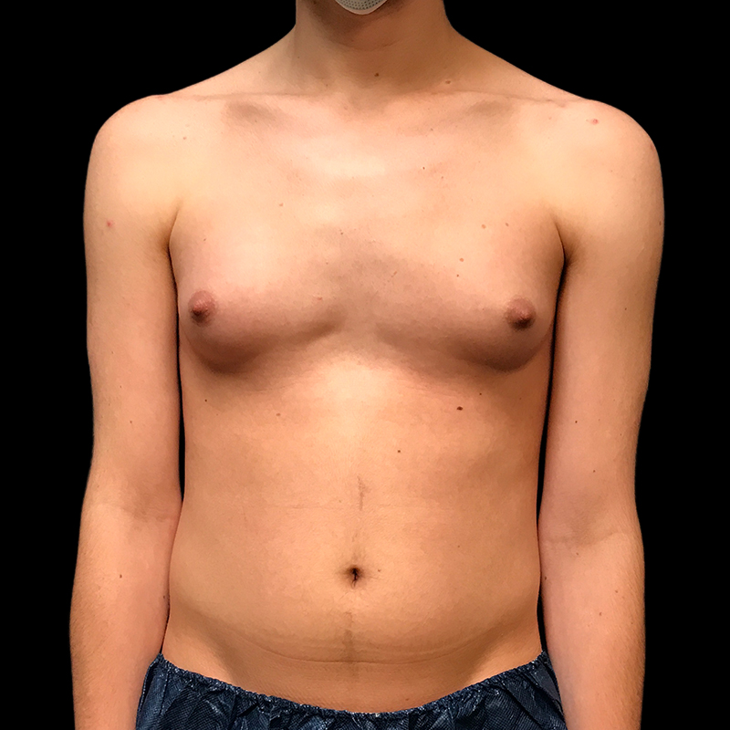 Ftm Keyhole Chest Reconstruction 01