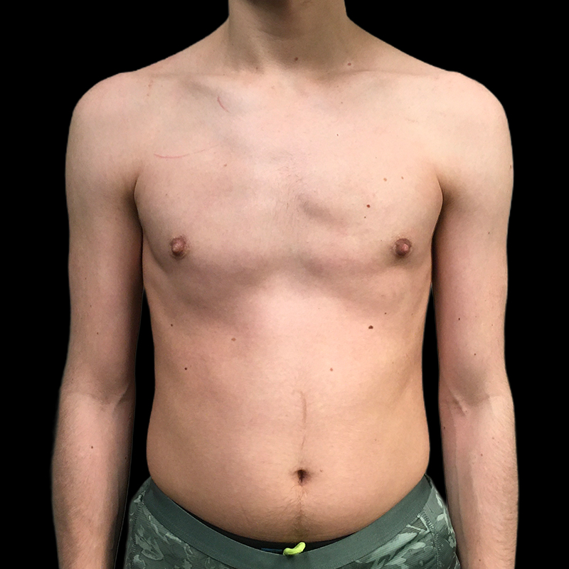 Ftm Keyhole Chest Reconstruction 01