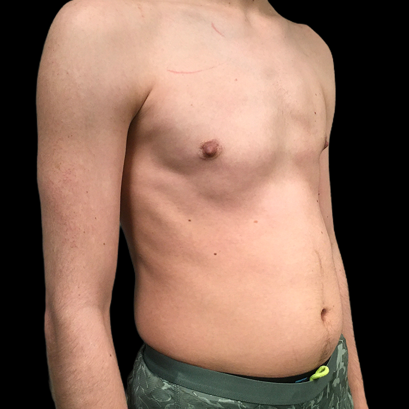 Ftm Keyhole Chest Reconstruction 03