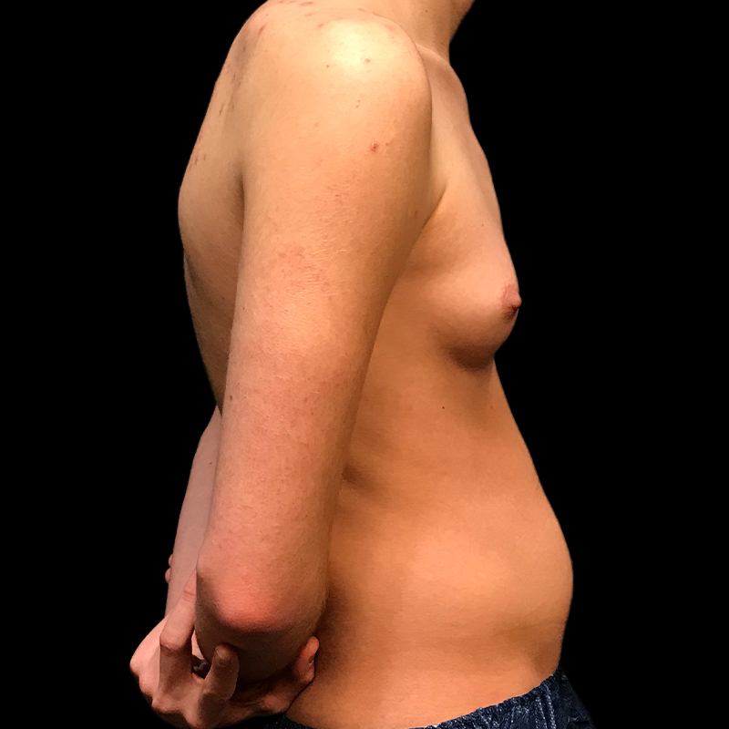 Ftm Keyhole Chest Reconstruction 05