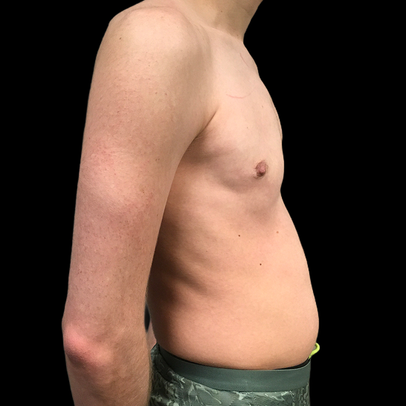 Ftm Keyhole Chest Reconstruction 05