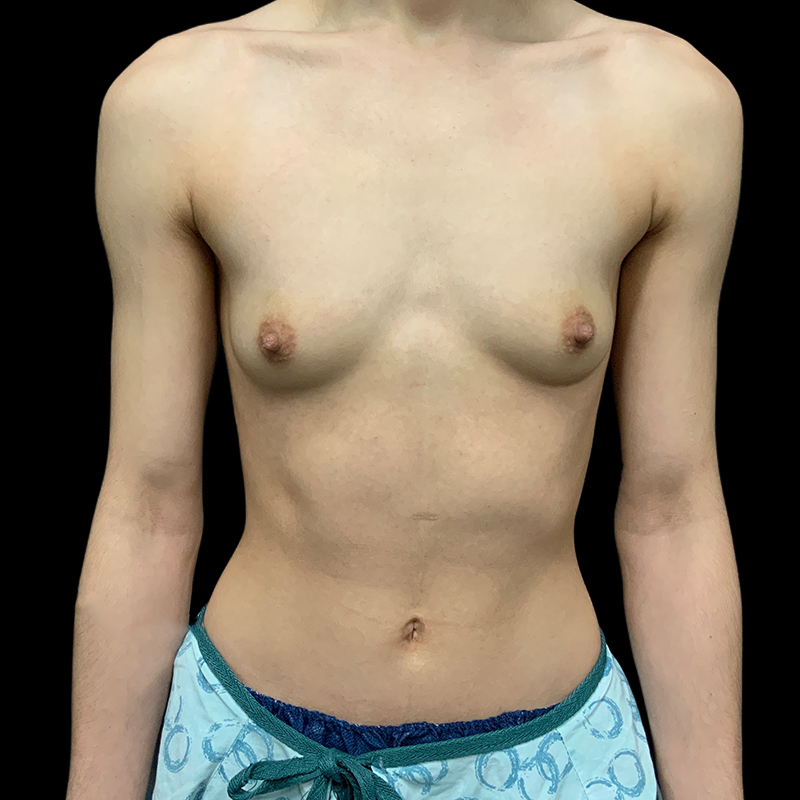 Ftm Keyhole Chest Reconstruction 01