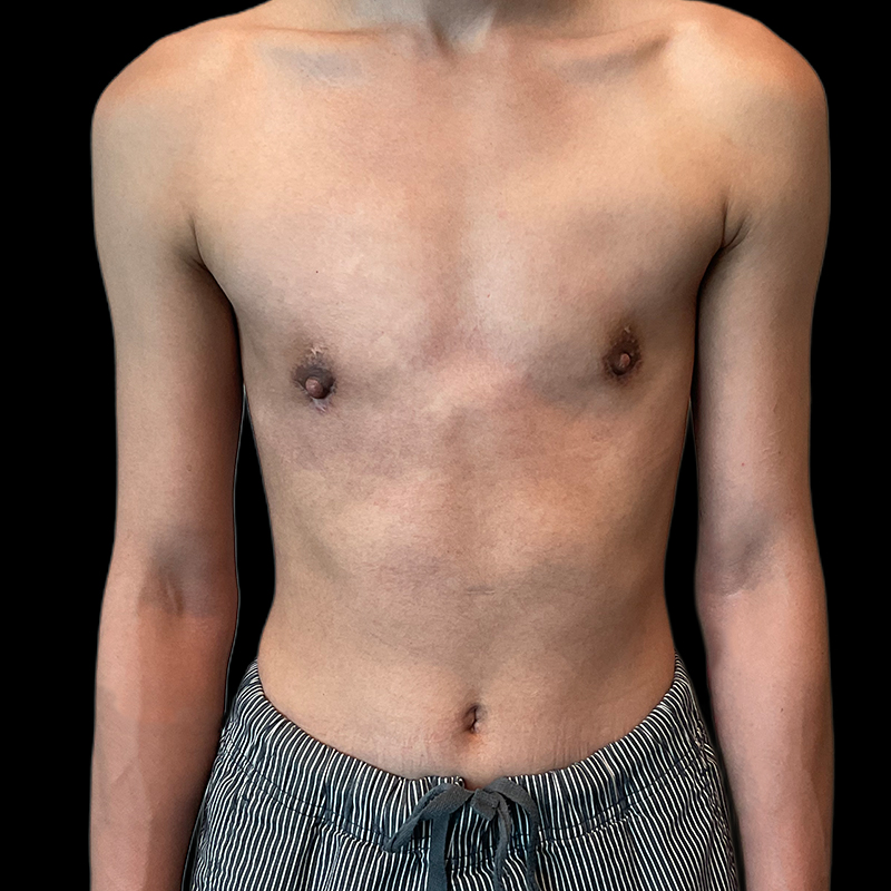 Ftm Keyhole Chest Reconstruction 07