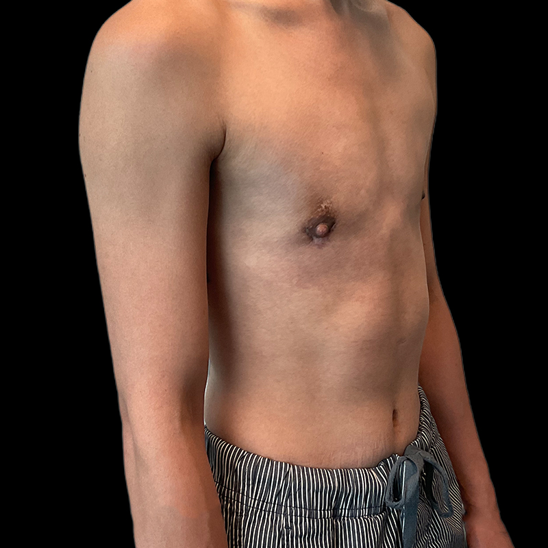 Ftm Keyhole Chest Reconstruction 03