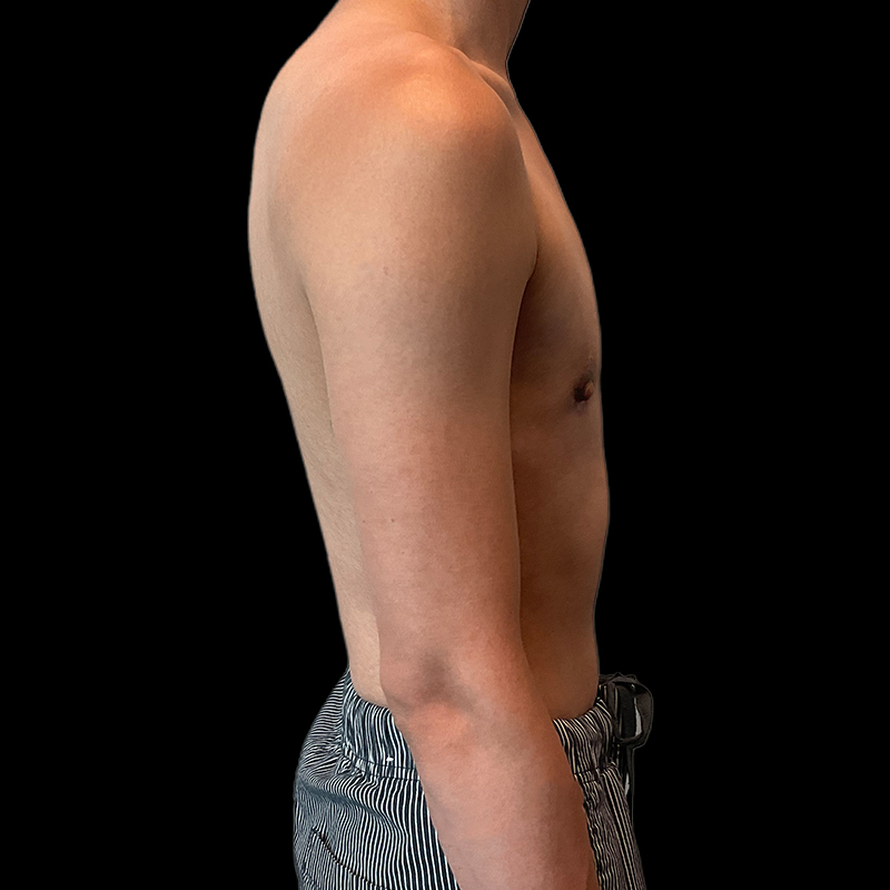 Ftm Keyhole Chest Reconstruction 05