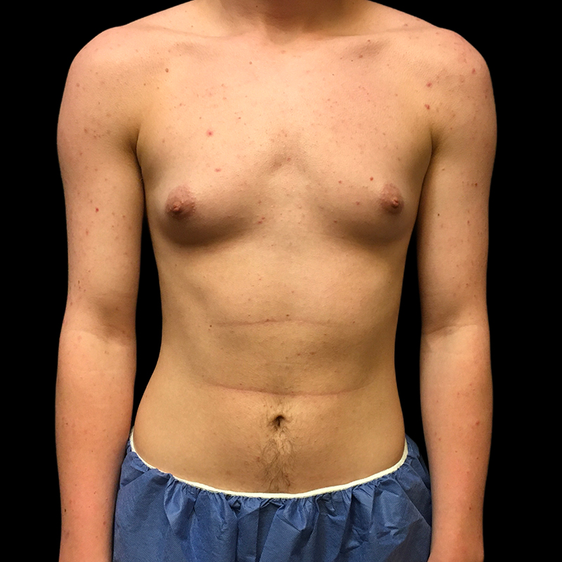 Ftm Keyhole Chest Reconstruction 01