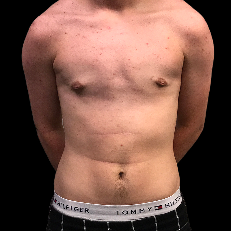 Ftm Keyhole Chest Reconstruction 08