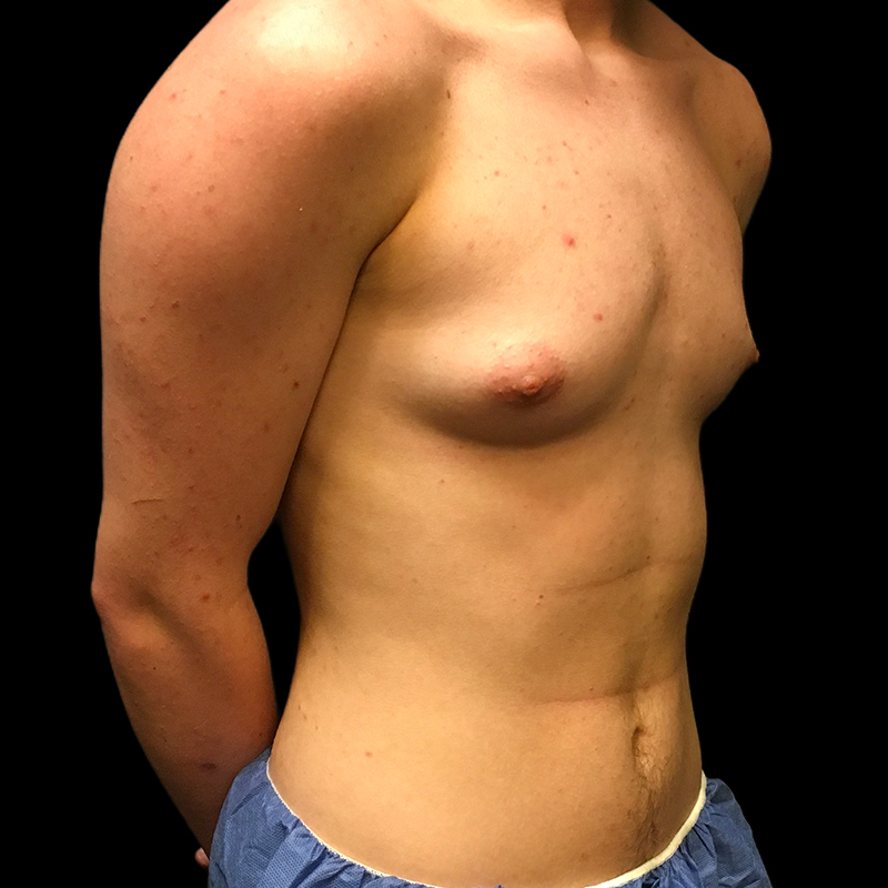 Ftm Keyhole Chest Reconstruction 03
