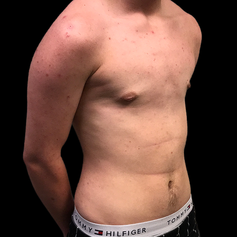 Ftm Keyhole Chest Reconstruction 03