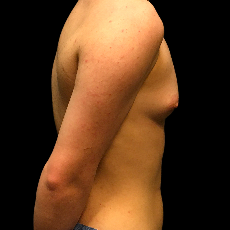 Ftm Keyhole Chest Reconstruction 05