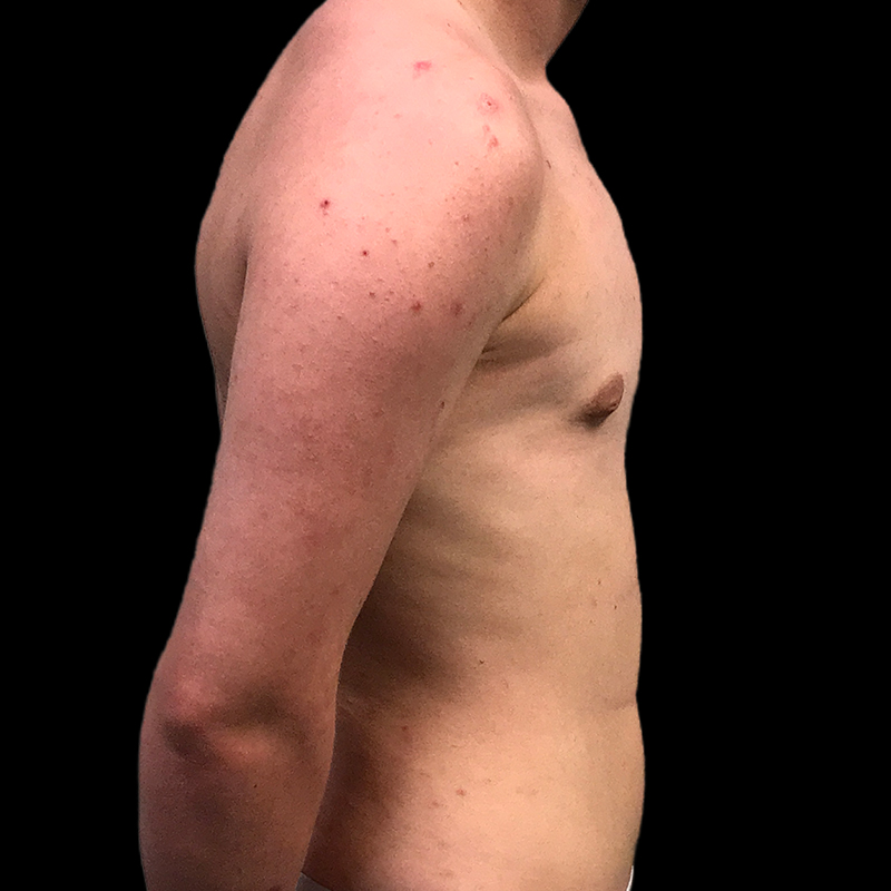 Ftm Keyhole Chest Reconstruction 05