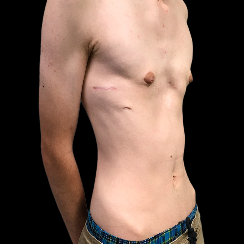 Ftm Keyhole Chest Reconstruction 09