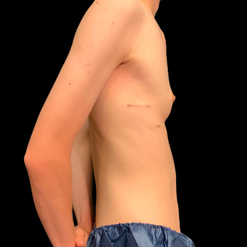 Ftm Keyhole Chest Reconstruction 03