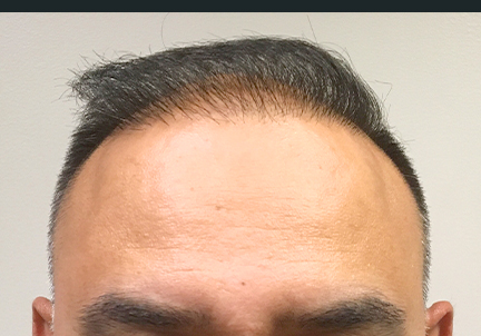 Fue Hair Transplant 03