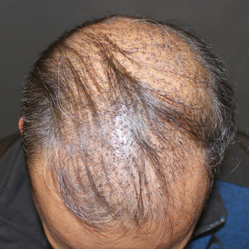 Fue Hair Transplant 01