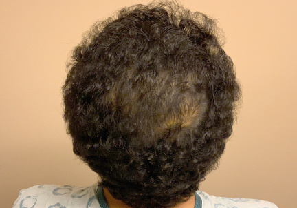 Fue Hair Transplant 01