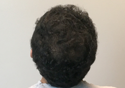 Fue Hair Transplant 03