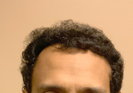 Fue Hair Transplant 03