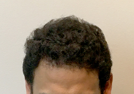 Fue Hair Transplant 03