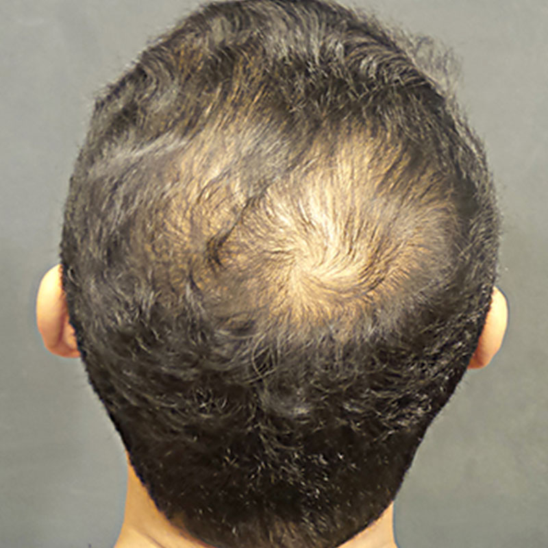 Fue Hair Transplant 01