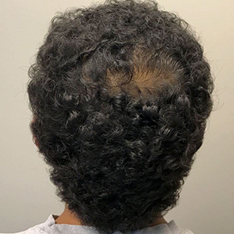 Fue Hair Transplant 05