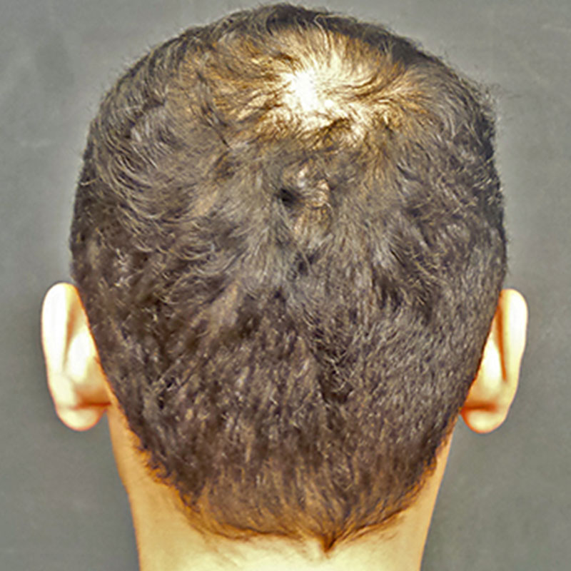 Fue Hair Transplant 03