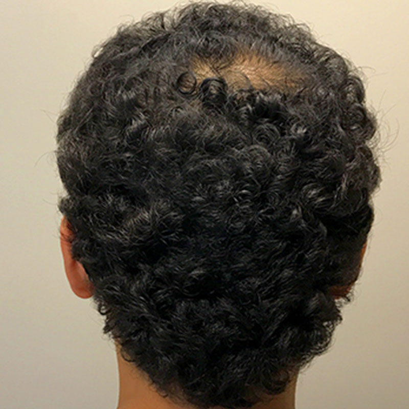 Fue Hair Transplant 03