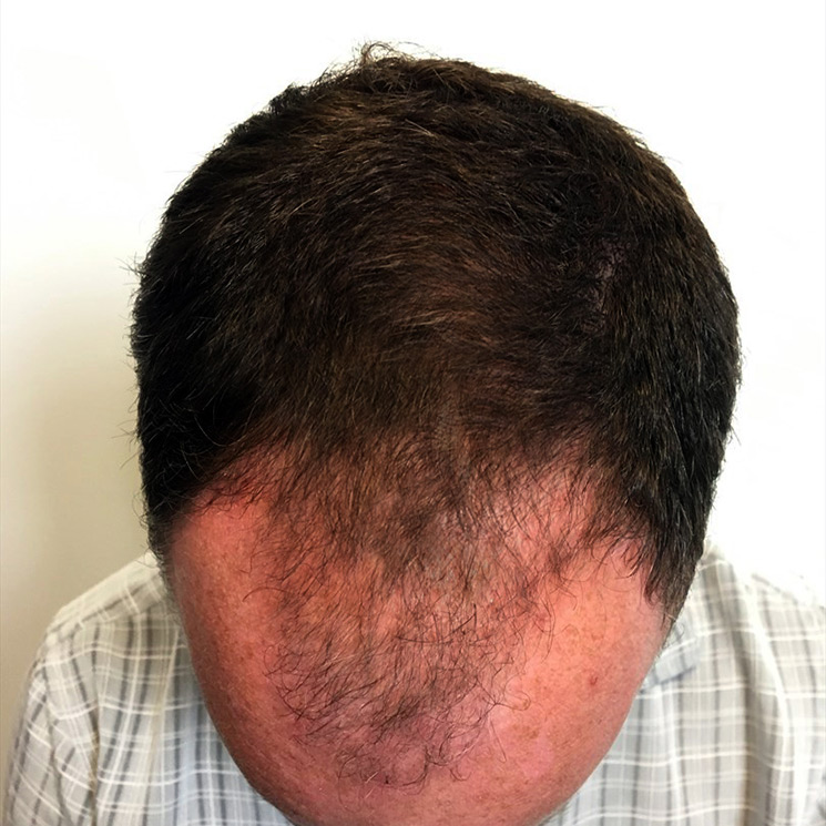 Fue Hair Transplant 06
