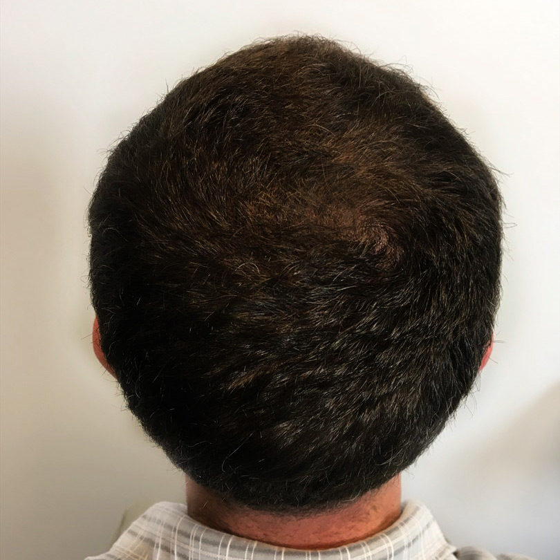 Fue Hair Transplant 03