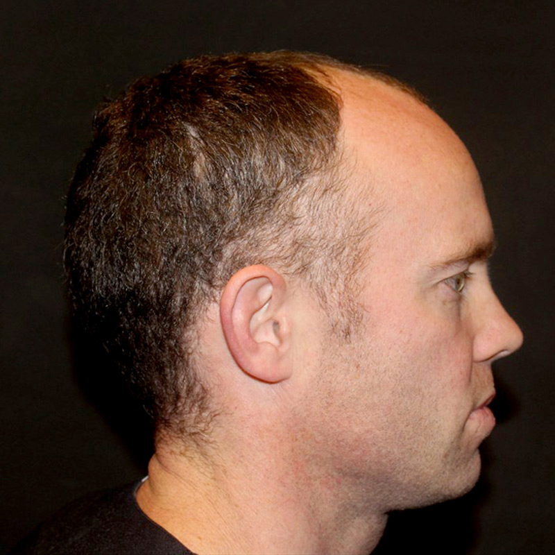 Fue Hair Transplant 05