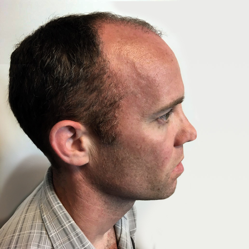 Fue Hair Transplant 05