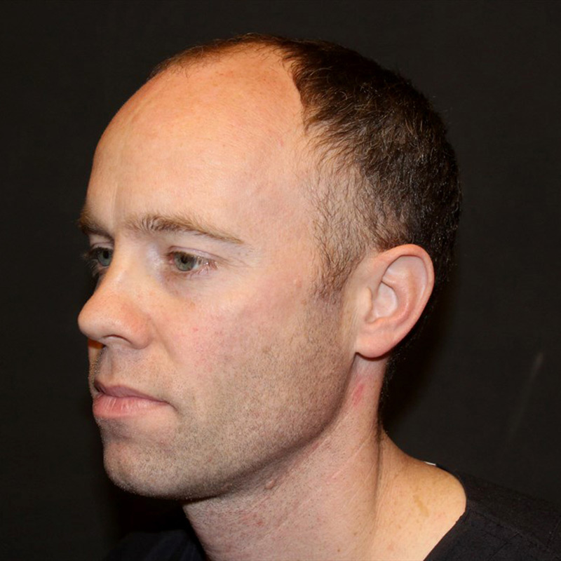 Fue Hair Transplant 07