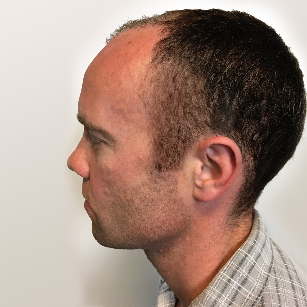 Fue Hair Transplant 09