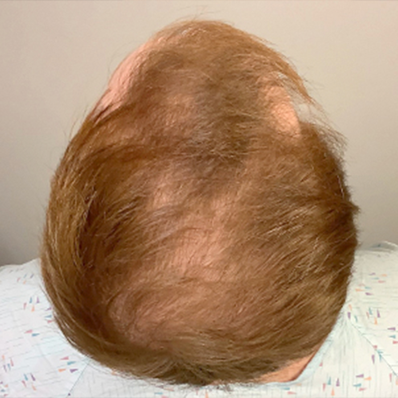 Fue Hair Transplant 01