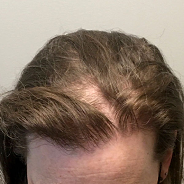 Fue Hair Transplant 09