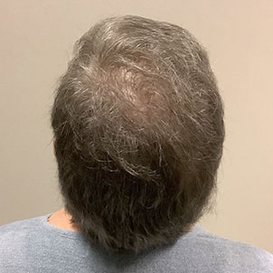 Fue Hair Transplant 01