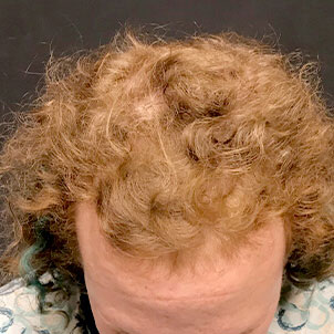 Fue Hair Transplant 01