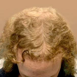 Fue Hair Transplant 11