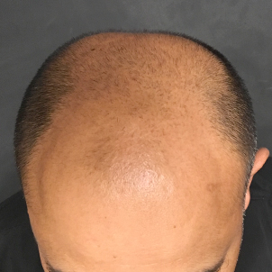 Fue Hair Transplant 01