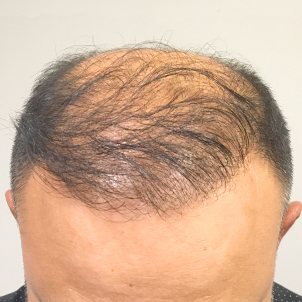 Fue Hair Transplant 12