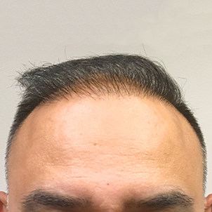 Fue Hair Transplant 03