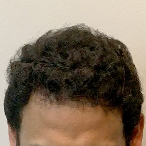 Fue Hair Transplant 03