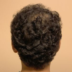 Fue Hair Transplant 05